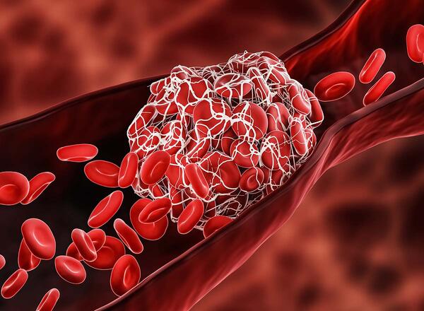 illustration of blood clot in vessels