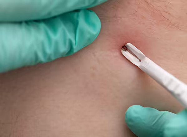 person wearing gloves to use a tweezer to remove a tick